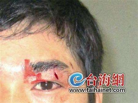广东一男子啤酒瓶爆炸致眼睛八级伤残 生产商被判赔偿11万